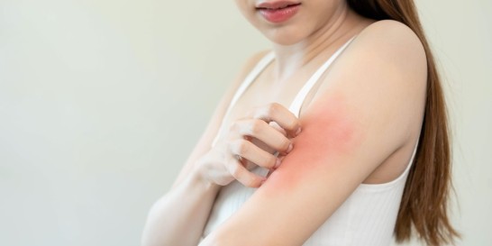 Eczema & Atopic Dermatitis