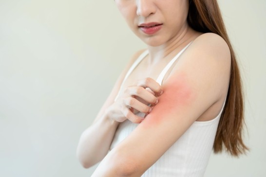 Eczema & Atopic Dermatitis